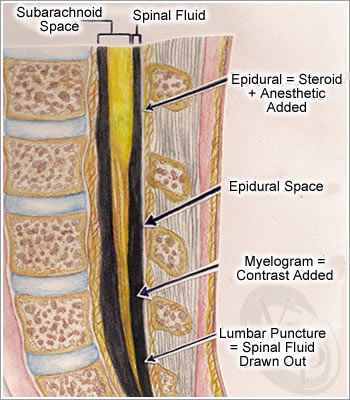 Epidural steroid injections for lumbar spinal stenosis side effects