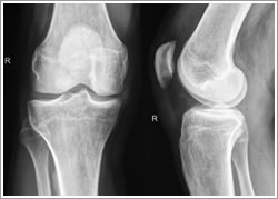 pic-knee-arthrogram